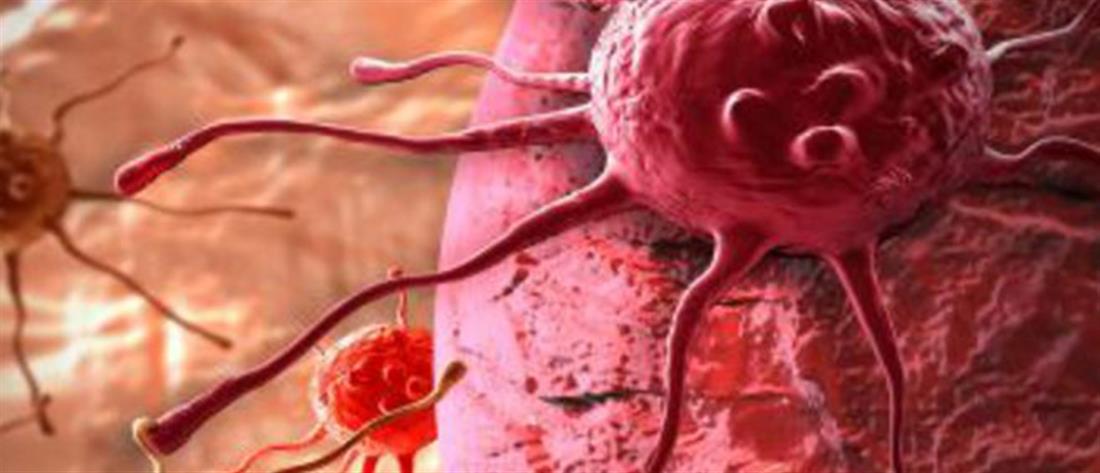 Ραδιοεμβολισμός: νέα θεραπευτική αντιμετώπιση του καρκίνου του Ήπατος