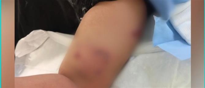 Σοκ στο Πέραμα: Σκύλος επιτέθηκε και τραυμάτισε 12χρονο έξω από σχολείο