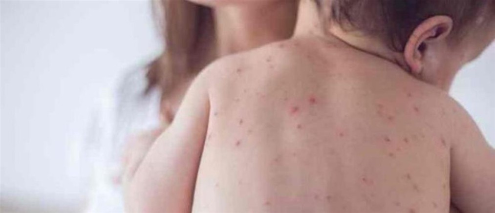 ΕΟΔΥ: Η ιλαρά εξακολουθεί να προκαλεί σοβαρές επιπλοκές - Γιατί ο εμβολιασμός παραμένει κρίσιμος