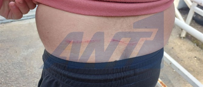 Τατόι - Επίθεση λύκου σε περιπατητή: Με δάγκωσε στη μέση και με έγδαρε